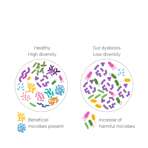Illustration comparing a diverse, healthy gut microbiome to a dysbiotic gut with reduced diversity and increased harmful bacteria.