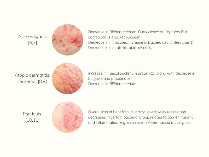 Table showing gut microbiota alterations associated with acne, eczema, and psoriasis, highlighting decreased microbial diversity and specific bacterial shifts.
